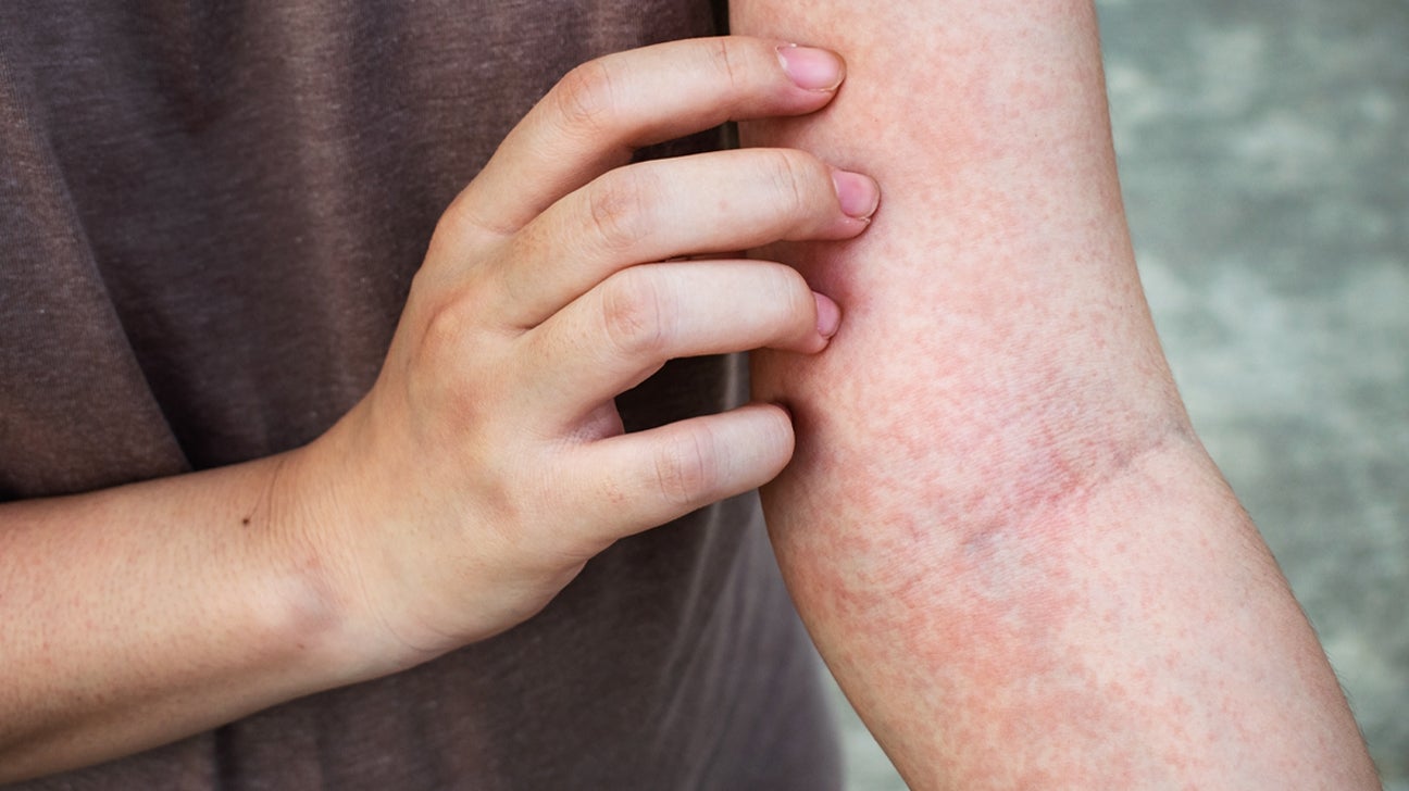 Itching: What's Causing Your Itchy Skin? (with Pictures)